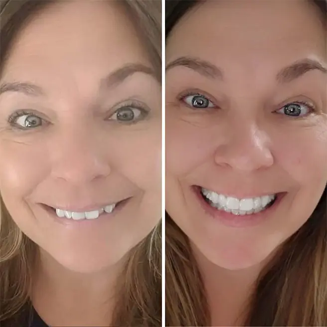 Invisalign before and after treatment