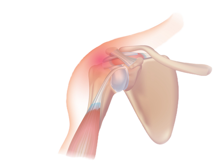 Rotator Cuff Impingement Syndrome