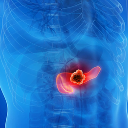 Cáncer de páncreas: uno de los más letales por su diagnóstico tardío