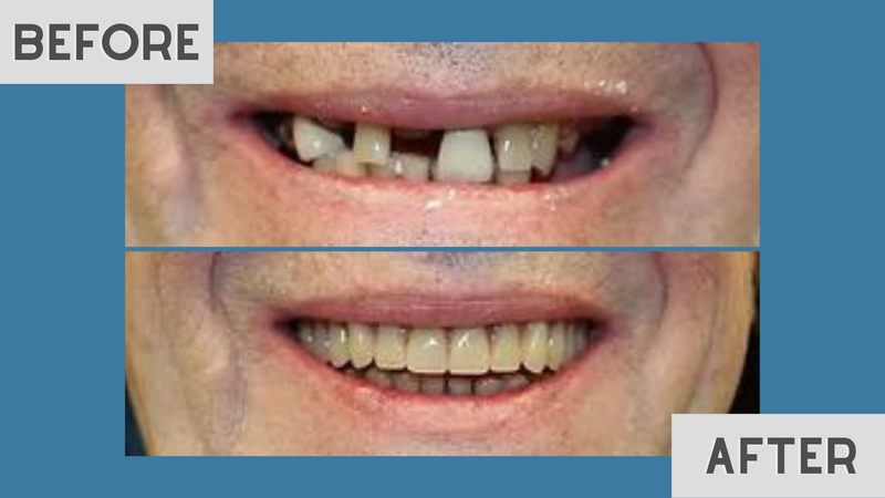 Before and after: multiple missing teeth restored to a full, even smile