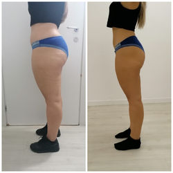 Abdomen Waist Before & After Lt Side