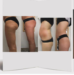 Thighs Cellulite & Abdomen Before & After Lt Side