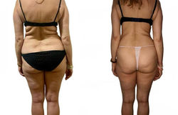 Back Buttocks Thighs Before & After
