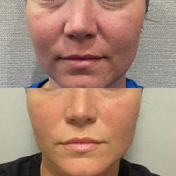 Megan Lip Filler & PDO Threads 2wks Before & After