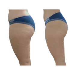 Buttocks Before & After 3 treatments (side 2)