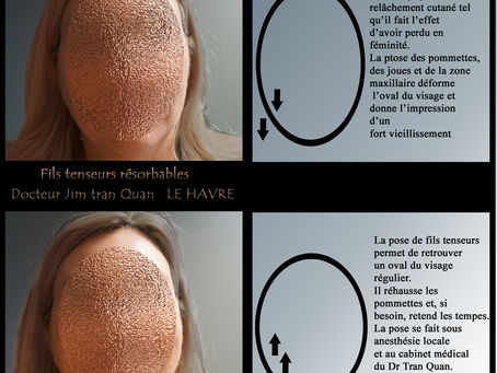 FILS TENSEURS RESORBABLES.  Dr Jim Tran Quan. Clinique des Ormeaux. Le Havre