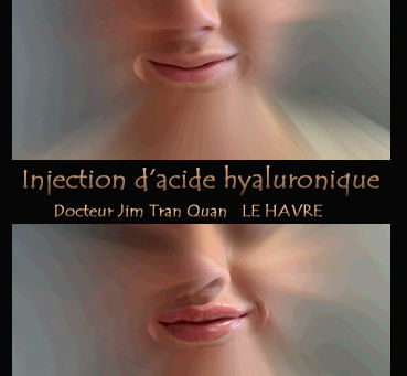 VOLUME DANS LES LEVRES