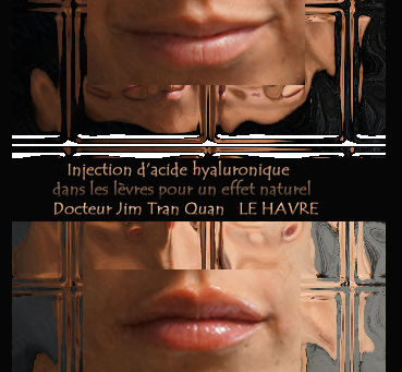 ACIDE HYALURONIQUE-LEVRES-DR TRAN QUAN