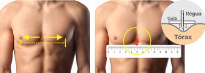 Local para colocar o vacuum bell pectus excavatum