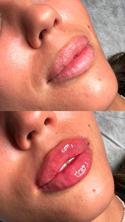 LIPS FILLER