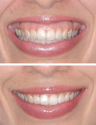 Botox sorriso gengival 2.jpg