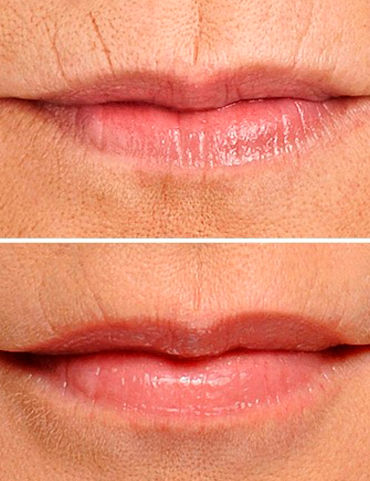 Botox_Código_de_Barras_4.jpg