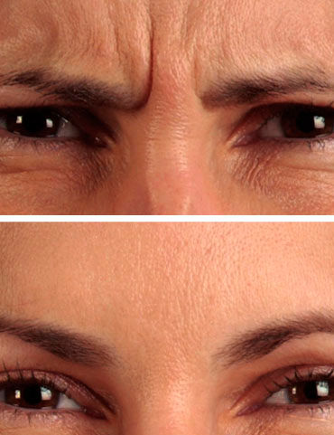 Botox Glabela 3.jpg