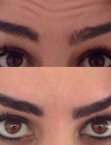 Botox Testa 1.jpg