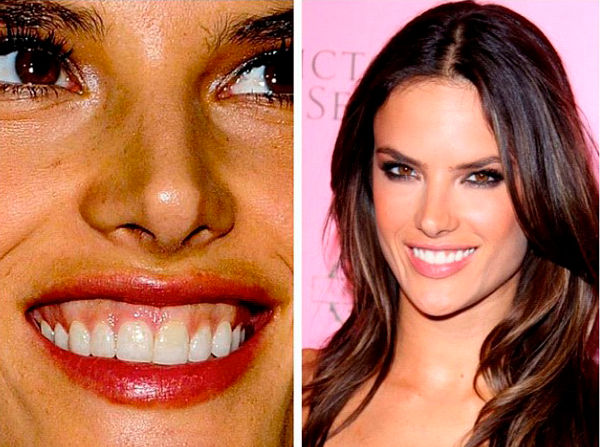 Botox sorriso gengival 1.jpg