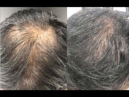 Discover Nue Strand™ for Real Hair Growth