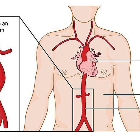 Abdominal Aortic Aneurysm (AAA)