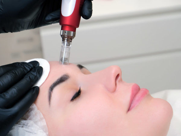 microneedling-treatment-600x450.jpg