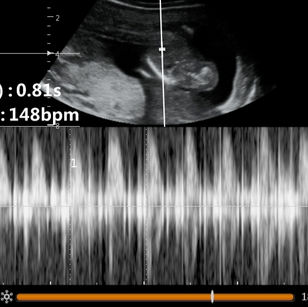 14 weeks 1 day pregnant 2D ultrasound picture of baby's heart rate
