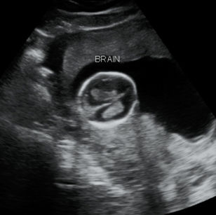 15 weeks 5 days pregnant 2D ultrasound picture of baby's brain