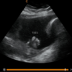 29 weeks pregnant 2D ultrasound picture of baby's toes