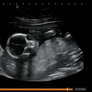 18-weeks-pregnant-2d-ultrasound-picture-baby-face