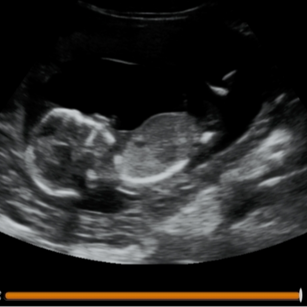 14 weeks 1 day pregnant 2D ultrasound picture of baby's profile