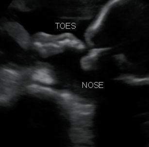 2D ultrasound picture at 26 weeks 6 days pregnant of baby's head and foot