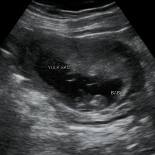 2D ultrasound picture at 9 weeks 4 days pregnant of baby