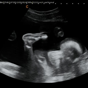 2D ultrasound picture at 24 weeks 4 days pregnant of baby's foot