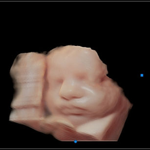 3D ultrasound picture at 31 weeks pregnant of baby's face in virtual hd