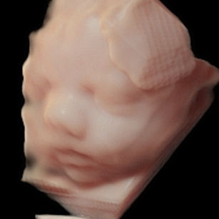 3D ultrasound picture at 31 weeks 4 days pregnant of baby's face in virtual HD