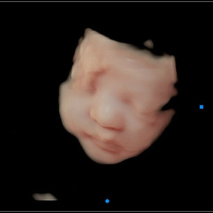 3D ultrasound picture at 31 weeks 1 day pregnant of baby's face in virtual hd