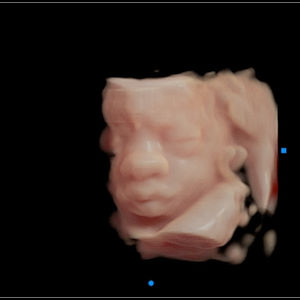 3D ultrasound picture at 27 weeks pregnant of baby's face in virtual HD