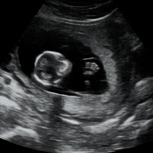 2D ultrasound picture at 13 weeks 3 days pregnant of baby's fingers