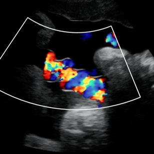 2D ultrasound picture of baby's cord blood flow at 37 weeks 3 days pregnant.