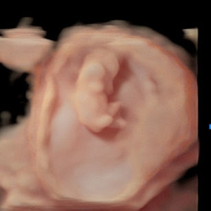 3D Ultrasound picture at 10 weeks 4 days pregnant of baby in the uterus in virtual HD