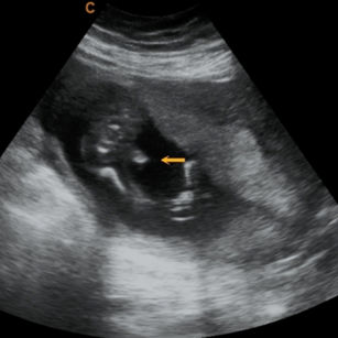 19 weeks pregnant 2d ultrasound picture baby's boy gender