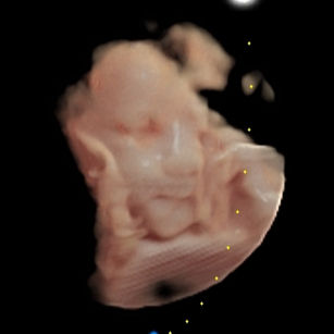 3D ultrasound picture at 33 weeks 6 days pregnant of baby's face in virtual HD