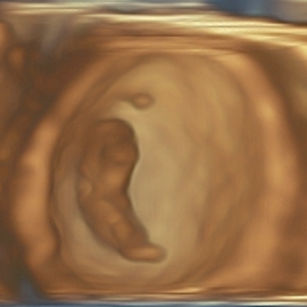 3D Ultrasound Picture at 9 Weeks 5 Days Pregnant of an intrauterine pregnancy