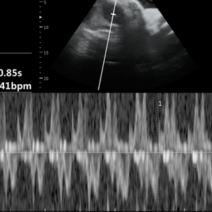 37 weeks 3 days pregnant 2d ultrasound baby heart rate picture