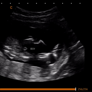 15 weeks 2 days pregnant of baby's Boy Gender