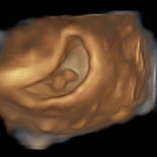 3D ultrasound picture at 6 weeks 4 days pregnant of baby in the uterus