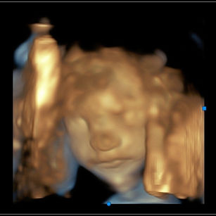 3D Ultrasound Picture at 24 weeks 1 day pregnant of baby's face