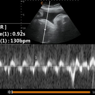 38 weeks 4 days pregnant 2D ultrasound of baby's fetal heart rate