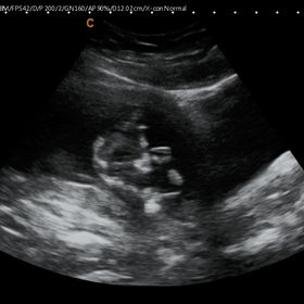 13 week pregnancy scan images