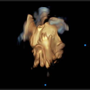 3D ultrasound picture at 31 weeks 6 days pregnant of baby's hand