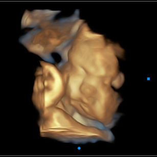 37 weeks 4 days pregnant 3d ultrasound picture of baby's face
