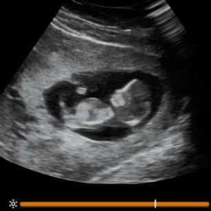 2D ultrasound picture at 11 weeks pregnant of baby's profile