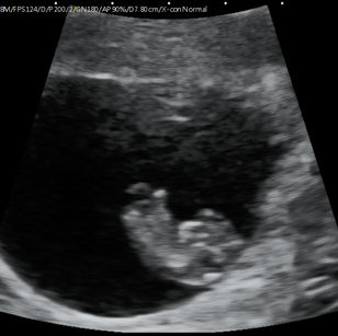 2D ultrasound picture at 9 weeks 4 days pregnant of baby